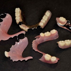 NON-FLEXIBLE DENTURES, SOME WITH METAL COMPONENTS
