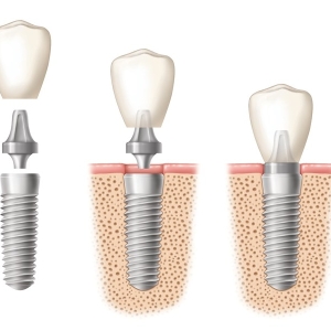 STAGES IN IMPLANTED TOOTH REPLACEMENT.
